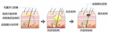 ​闭合性痤疮怎么治疗?(怎么治痤疮和闭合性粉刺)